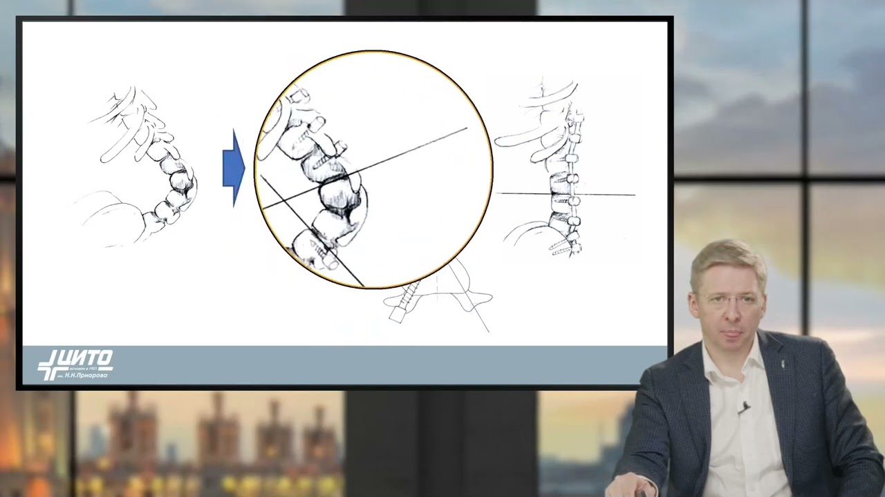 «Патология позвоночника при Spina bifida»