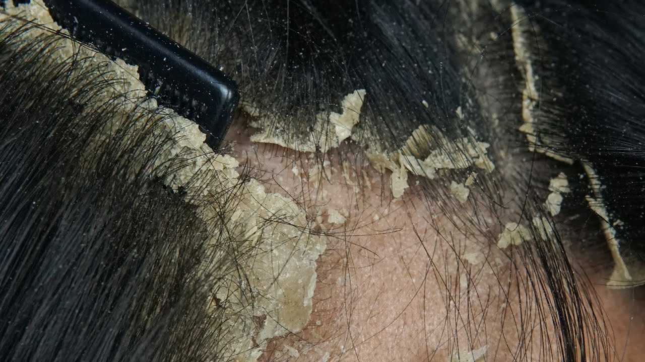 ASMR Satisfying Scalp Care: Cleaning Dandruff with Comb and Brush #51