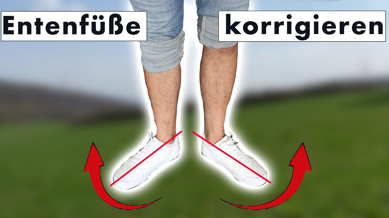 Fuß zeigt nach Außen (Entenfuß, Entengang) korrigieren | Ursache & SOFORTLÖSUNG