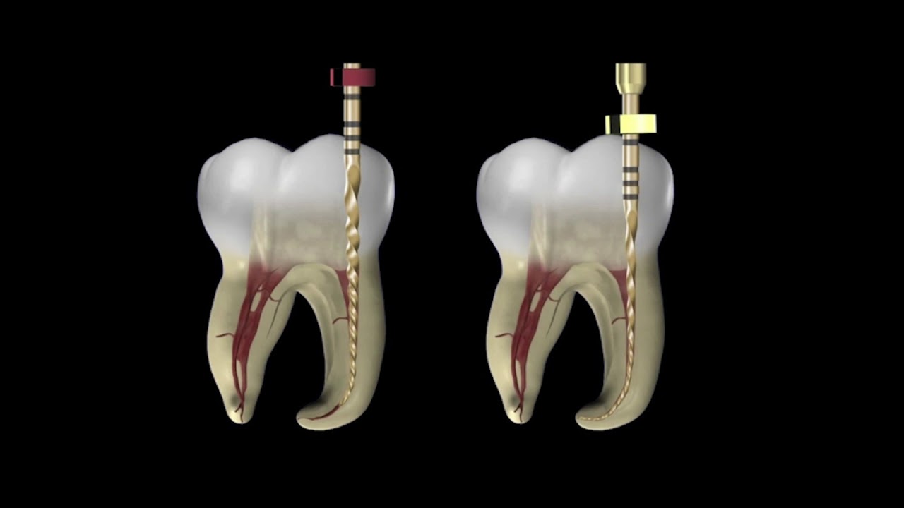 The WaveOne® Gold file system with Dr. Cliff Ruddle | Dentsply Sirona