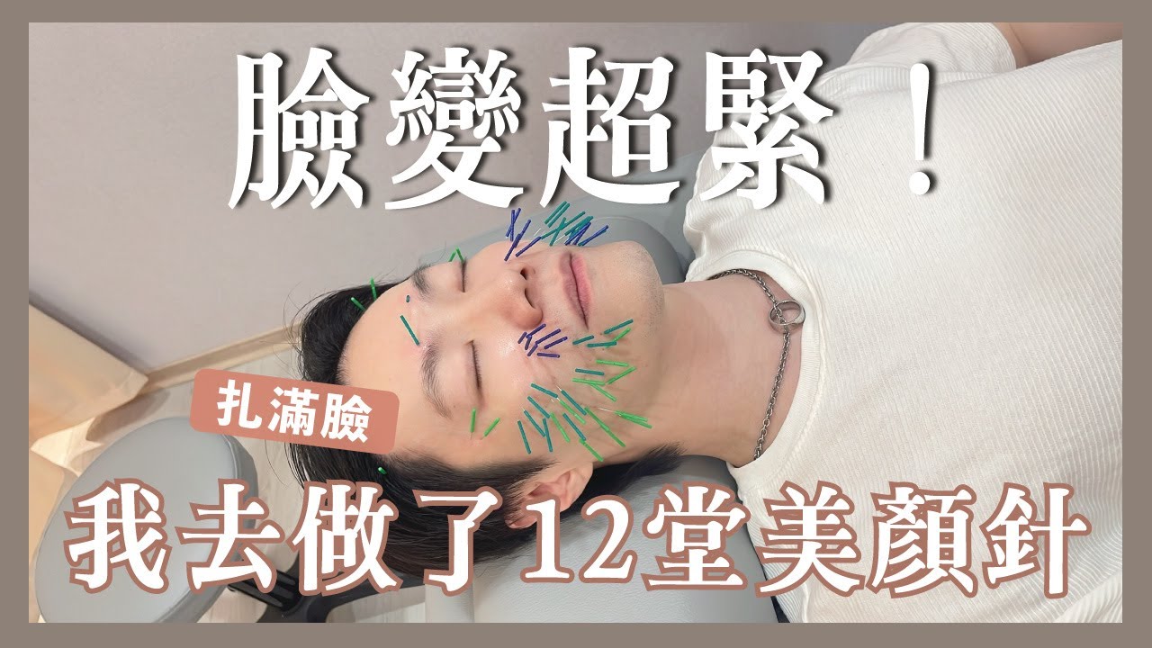 扎了幾百針的中醫美顏針體驗！拍照變超好看!?