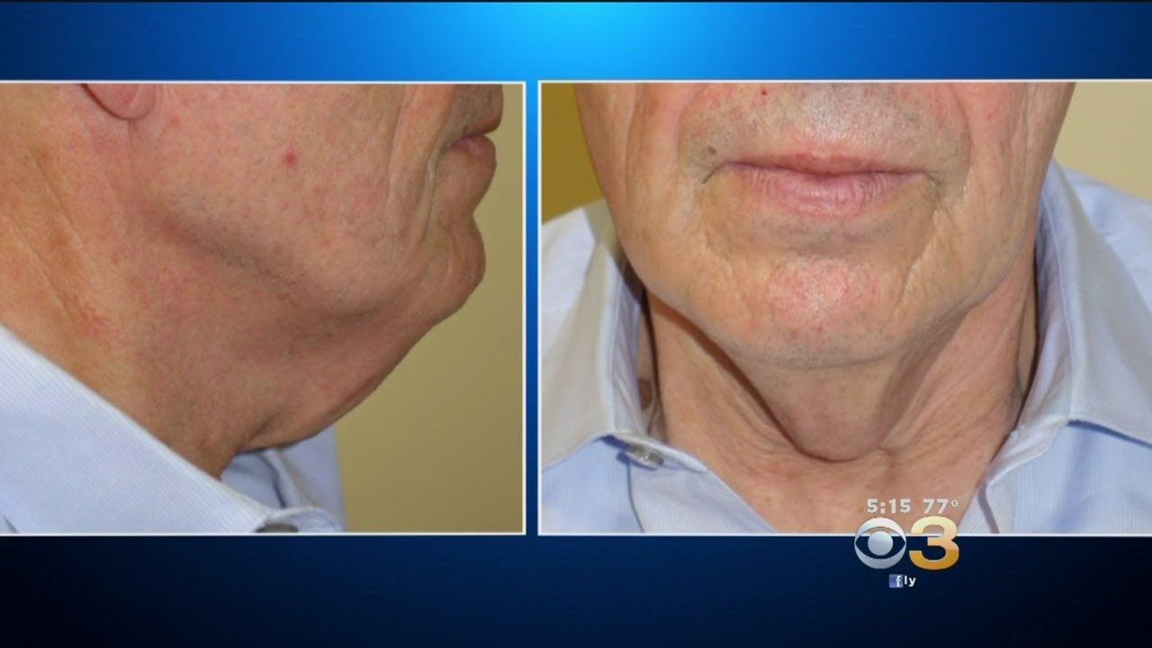 Plastic Surgeon Comes Up With Tie Tuck Procedure To Treat Saggy Necks