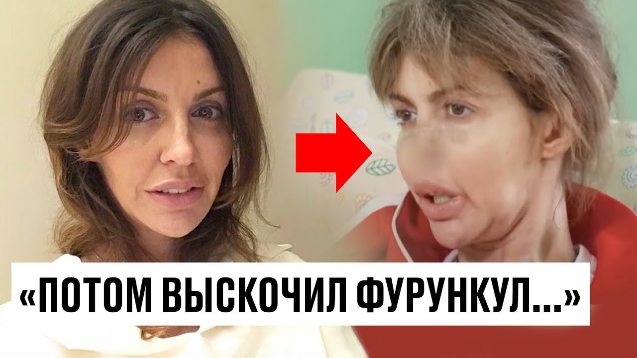 Алиса Казьмина откровенно рассказала что же случилось с ее лицом