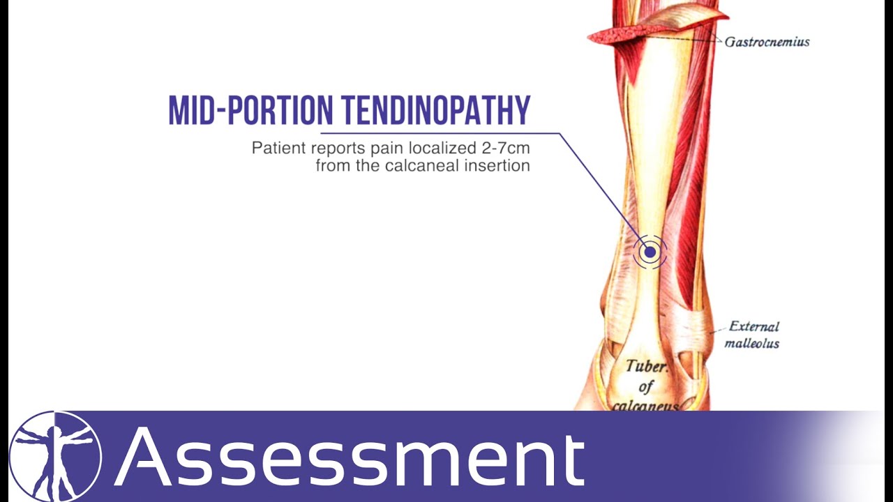 Diagnostic Tests for Midportion Achilles Tendinopathy