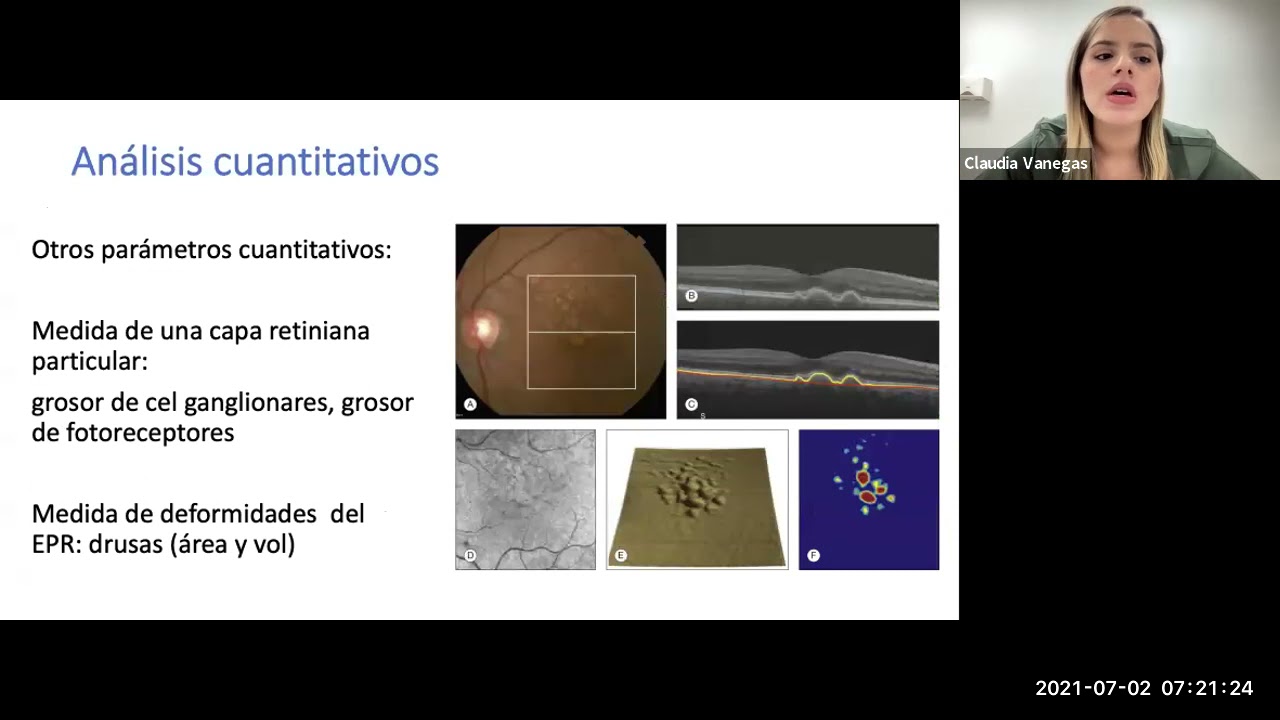 Tips básicos de OCT macula. Dra Claudia Vanegas. 2021-07-02