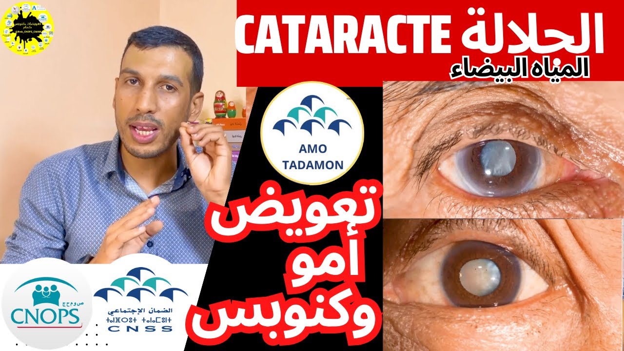 تعويض كنوبس و سنيسيس عملية الجلالة (الكاطاراكت، المياه البيضاء)  Cataracte AMO TADAMON