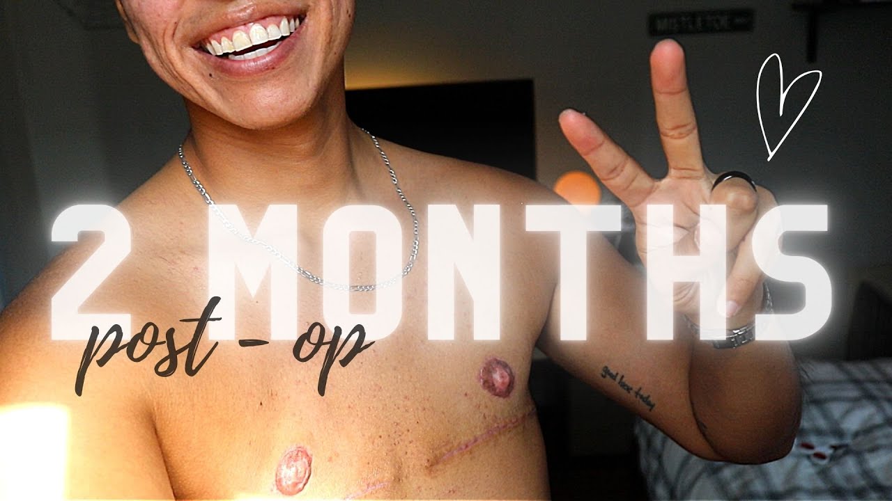 TOP SURGERY | 2 MONTHS POST OP :)