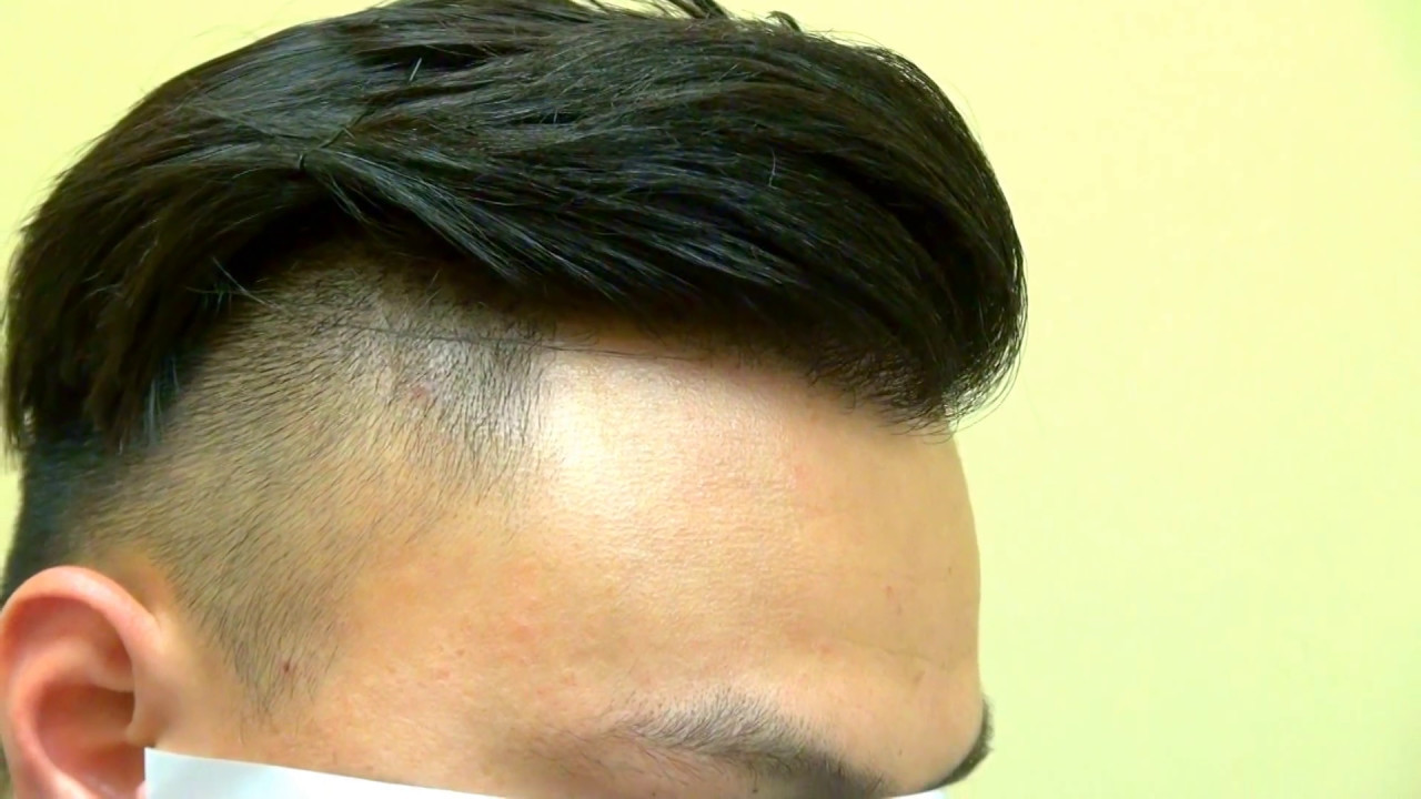 Asian Natural Hairline Restoration Surgery Hair Transplant by Dr. Diep 