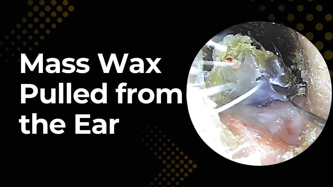 Mass wax pulled from the ear | earwax removal | ear cleaning | spa | ASMR