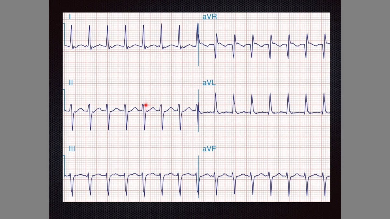 EKG patológico 2: Bradiarritmias y taquiarritmias