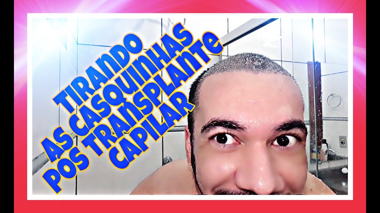 COMO TIRAR AS CASQUINHAS APÓS O TRANSPLANTE CAPILAR
