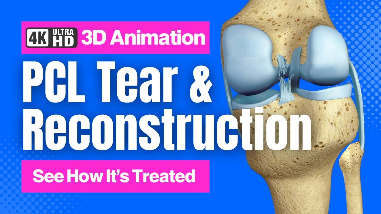 See how Surgeons fix PCL Tears - Patellar vs. Hamstring Graft Techniques - 4K 3D Animation