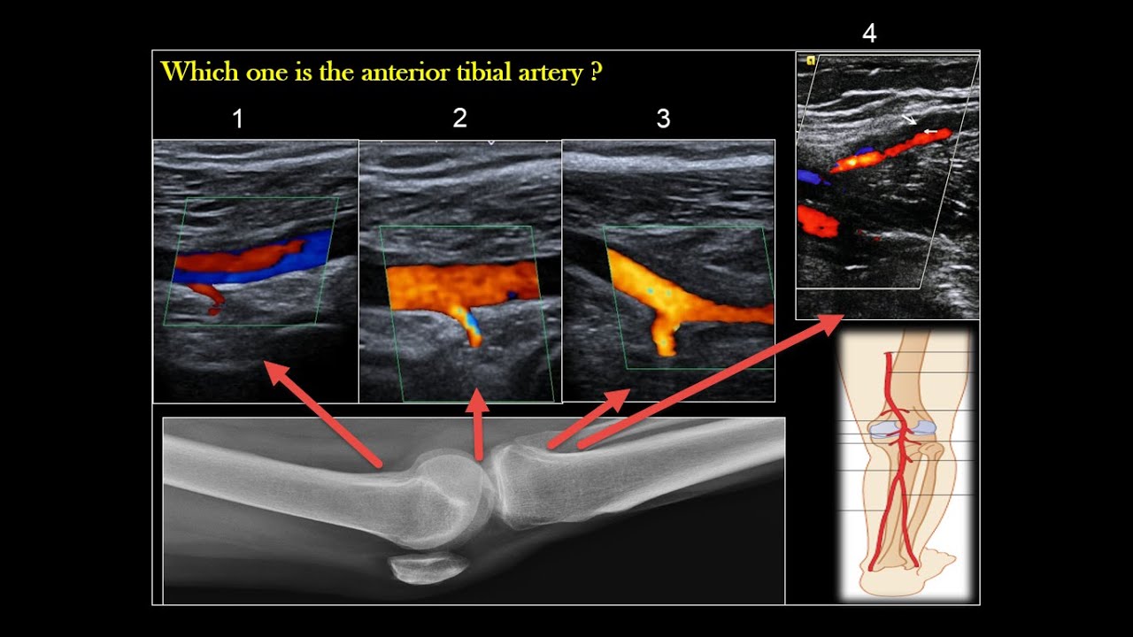 Doppler - Mimics of Anterior Tibial Artery
