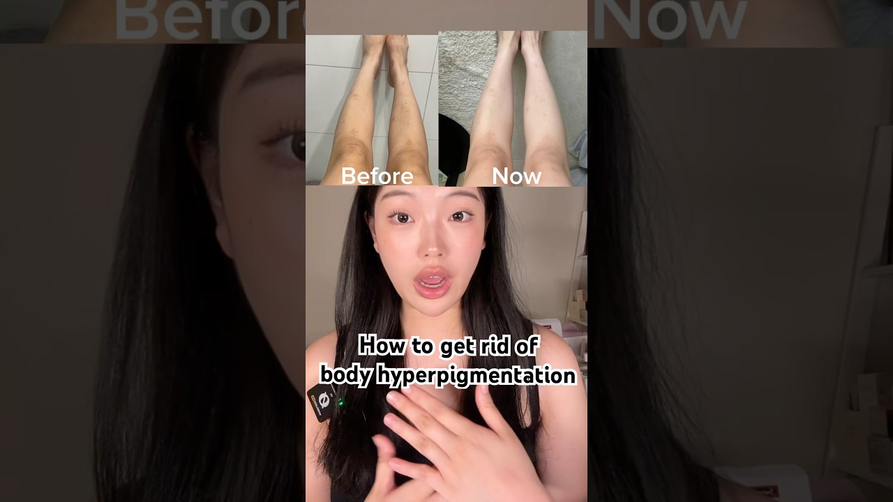 how to get rid of hyperpigmentation and achieve bright and even skin tone!! #kbeauty #brightening