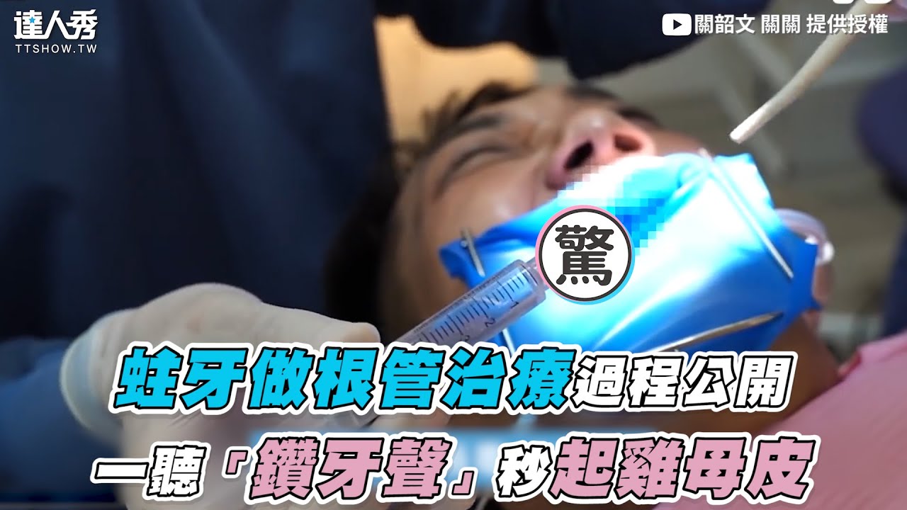 【蛀牙做根管治療過程公開 一聽「鑽牙聲」秒起雞母皮】｜@kuan_kuan