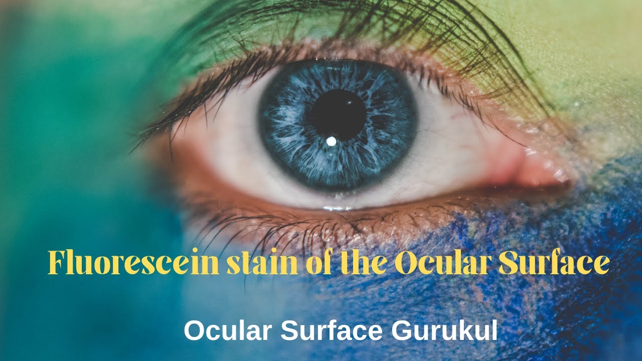 Fluorescein Staining of the Ocular Surface - The magical wand!My Movie 2