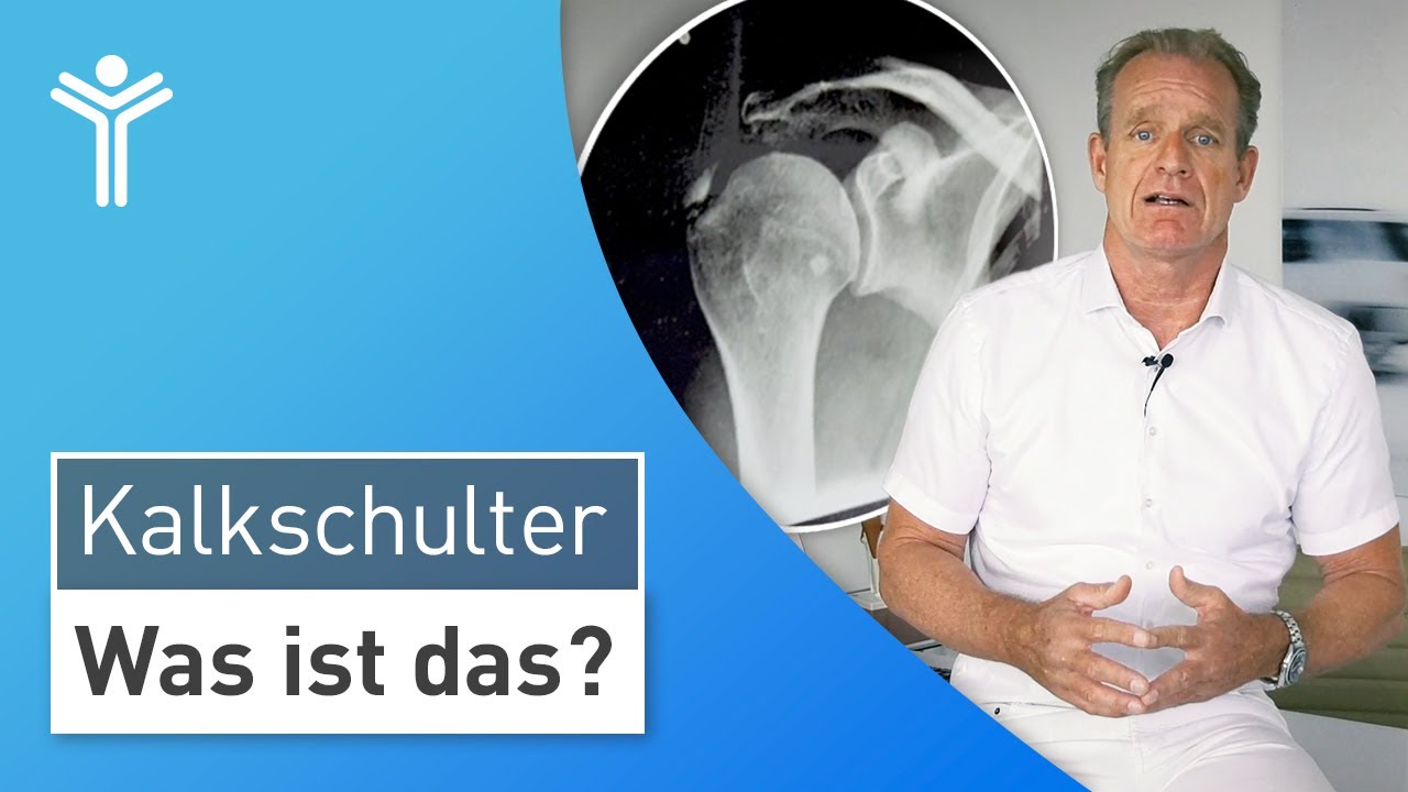 Kalkschulter einfach erkl&auml;rt: So entstehen Schulterschmerzen durch die Kalkschulter