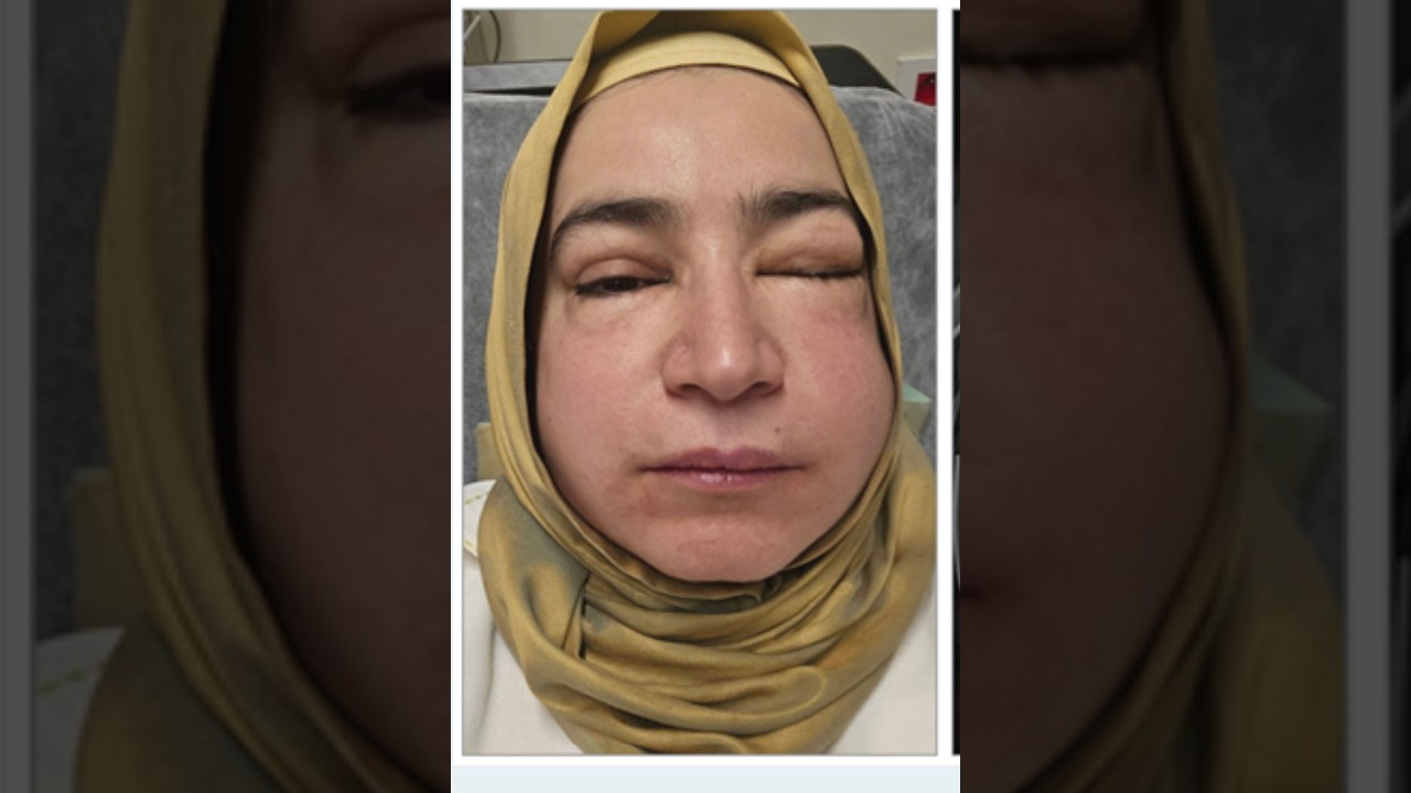 Endodontik Tedavi Esnasında Kanallar HAVA SIKILARAK KURULANMAMALI !