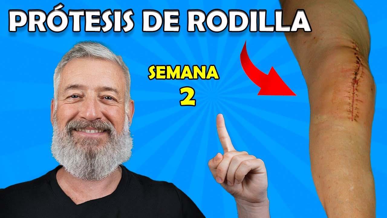 🦵 Semana 2 Prótesis de Rodilla Retirada de puntos (Grapas) y Ejercicios de Fortalecimiento