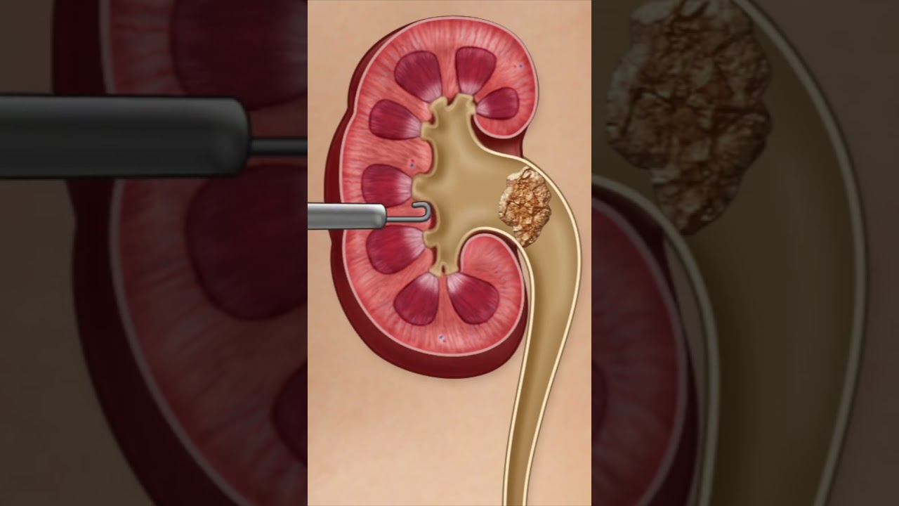 kidney stone procedure #kidneystone #calculus #ytshortsindia #youtubeshort #youtubescience #ytshorts
