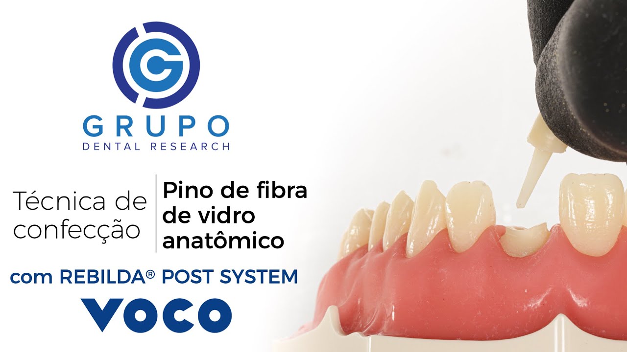 REBILDA POST System - Preparo e Cimentação de Pino anatômico de Fibra de Vidro. Como utilizar?