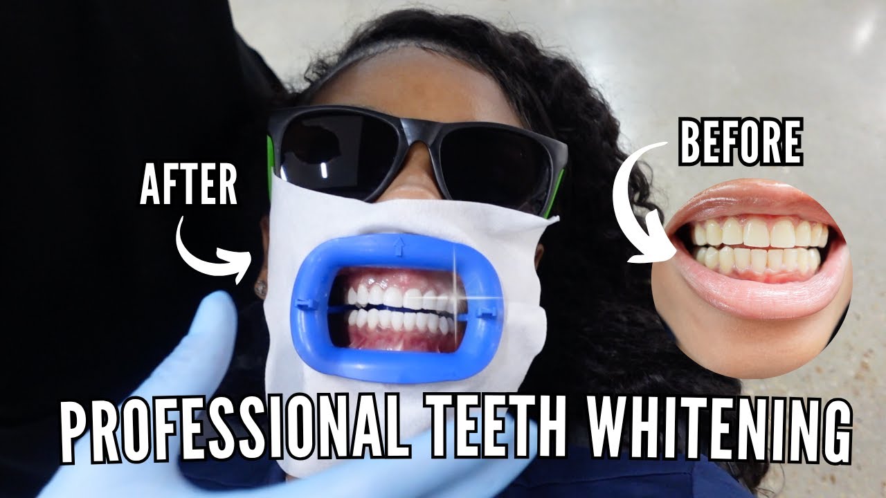 I Got My Teeth Professionally Whitened After Having Braces for 2 years! 🦷✨ | Real Results + Tips