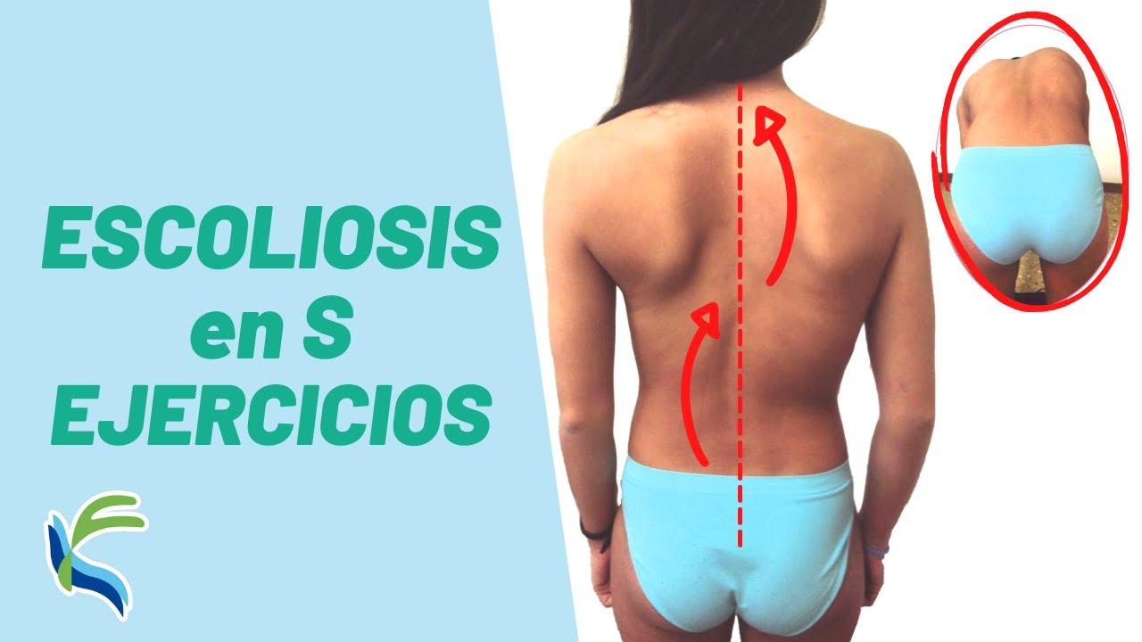 ESCOLIOSIS en S - EJERCICIOS evitar DOLOR y CORREGIR | Fisiolution
