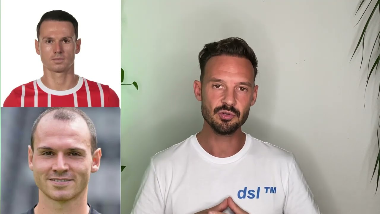 Warum ich meine zweite Haartransplantation nicht bei Elithairtransplant gemacht habe .