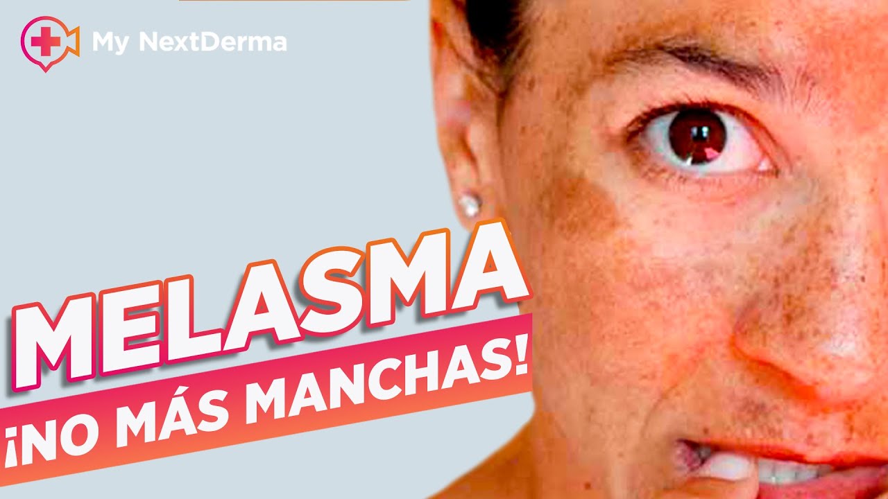 MELASMA / PAÑO / MANCHAS OSCURAS EN LA PIEL
