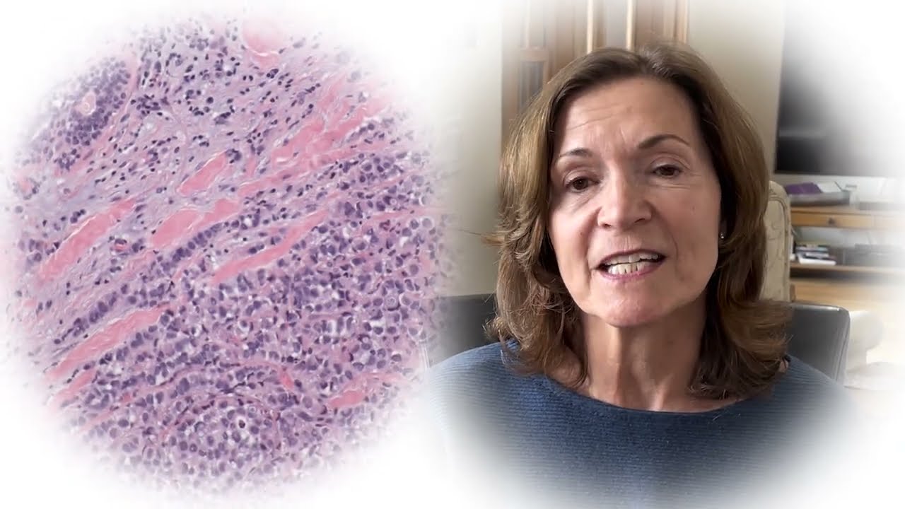 What Is Lobular Breast Cancer and What is LBCA?