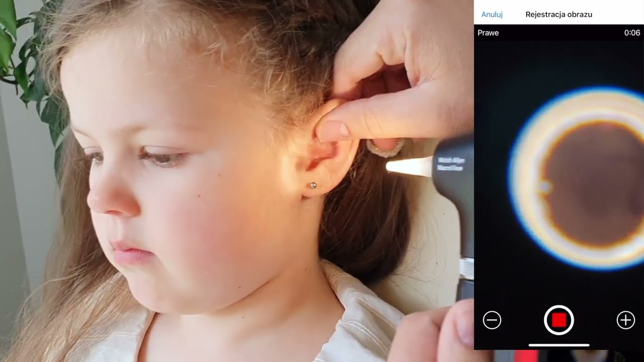 MacroView® Plus Otoskop WelchAllyn / Hillrom - konfiguracja i badanie pediatryczne, wideootoskop