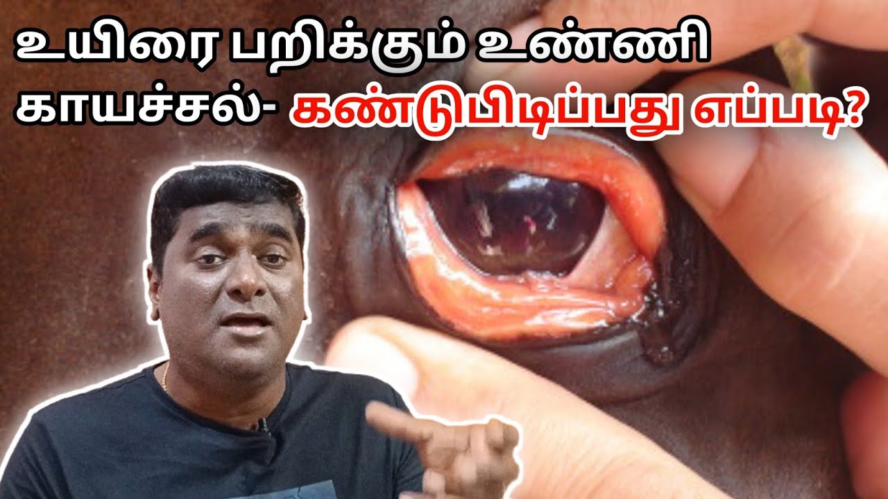Diagnosis of Tick Fever. உண்ணி காயச்சல்