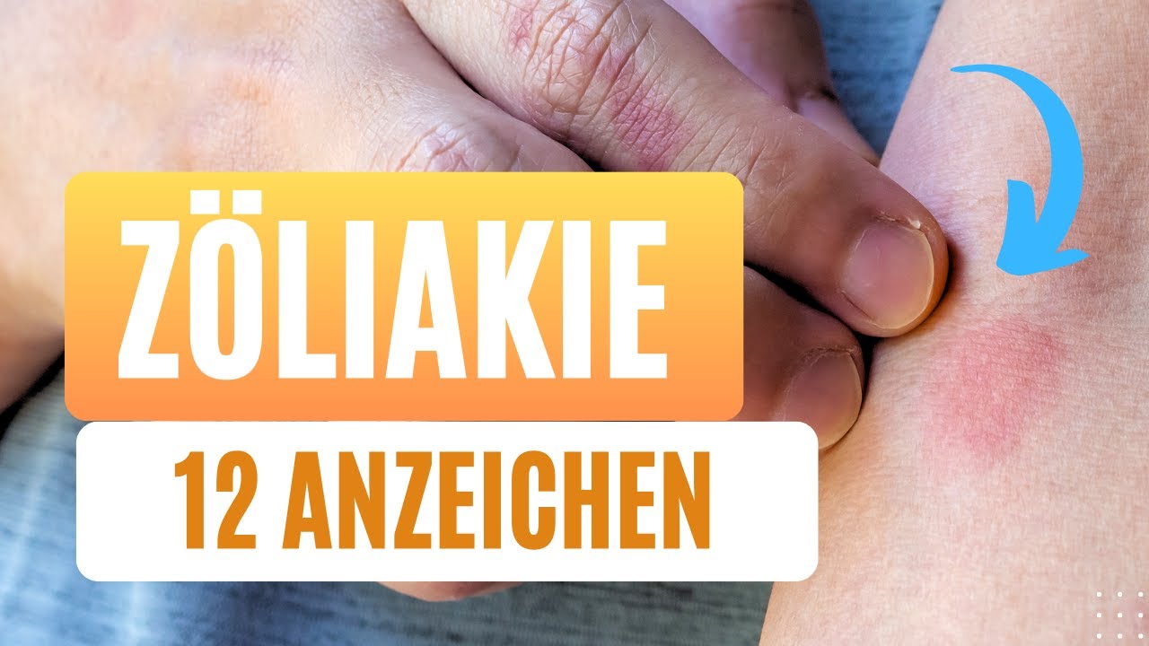 Du wirst dich wundern, welche Anzeichen bei Zöliakie auftreten können.:12 (überraschende) Symptome!