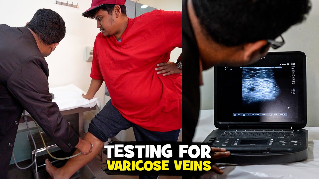 Varicose Veins Awareness | Avis - Irfan's View