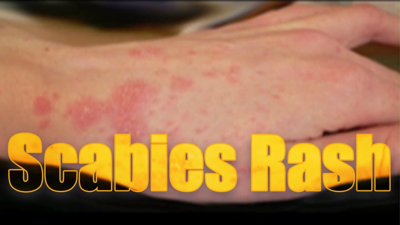 Scabies Rash: itchy, highly contagious skin disease | Usapang pangkalusugan