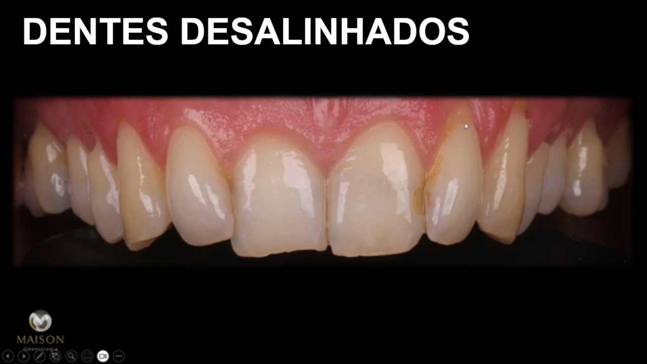Facetas de Resina Podem Corrigir Dentes Desalinhados ?