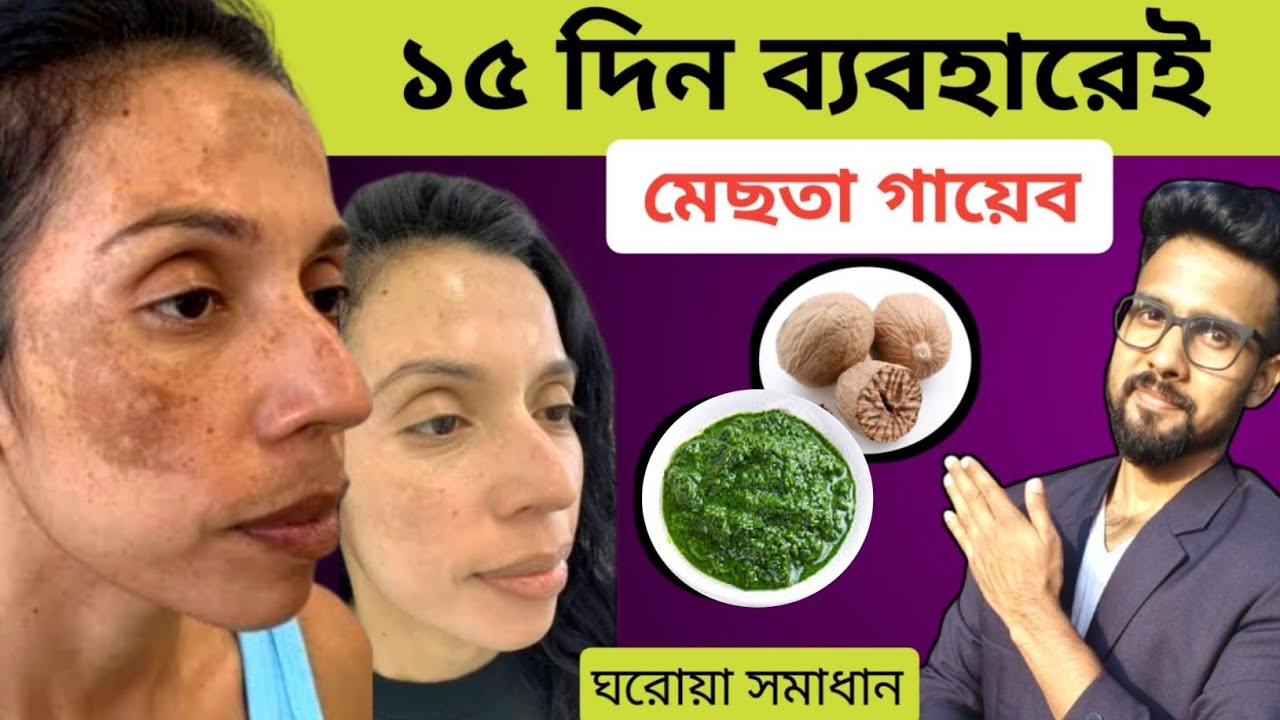 মেছতা দুর করার ঘরোয়া উপায় | Melasma home remedies ✅