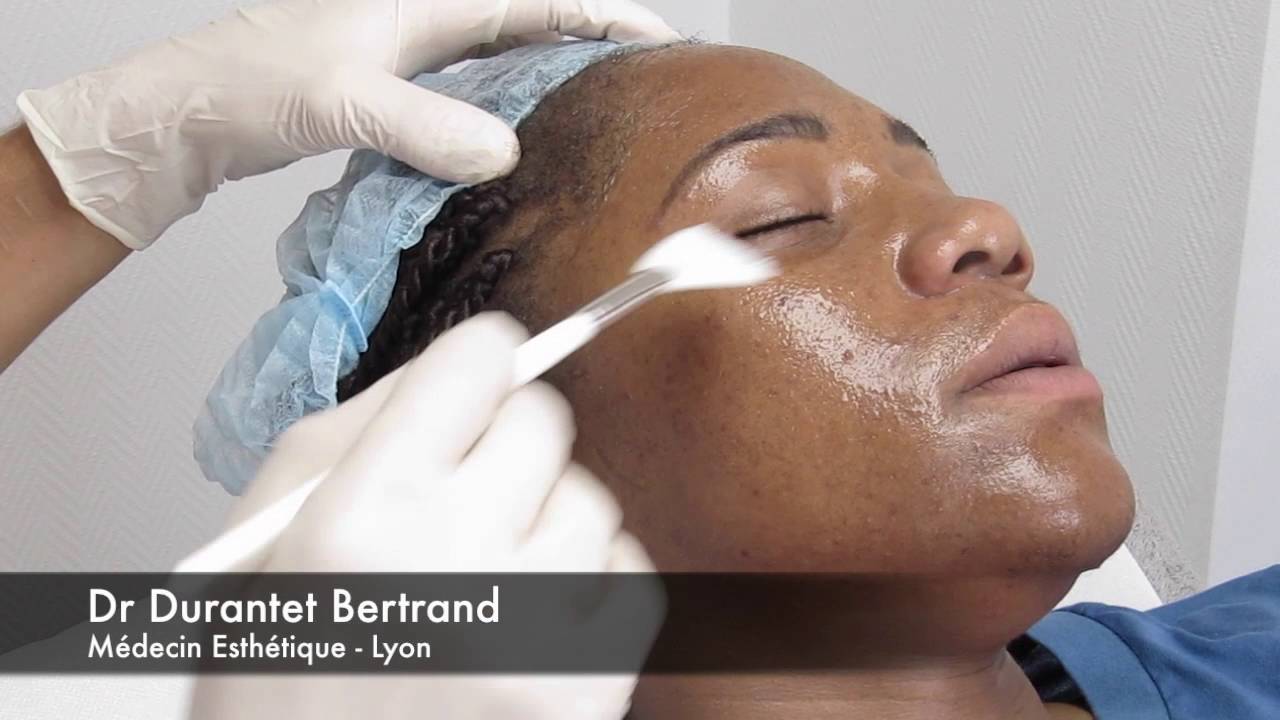 Peeling superficiel anti-acné : Alpha Béta Complex de Méné & Moy, par le Dr Durantet (Lyon)