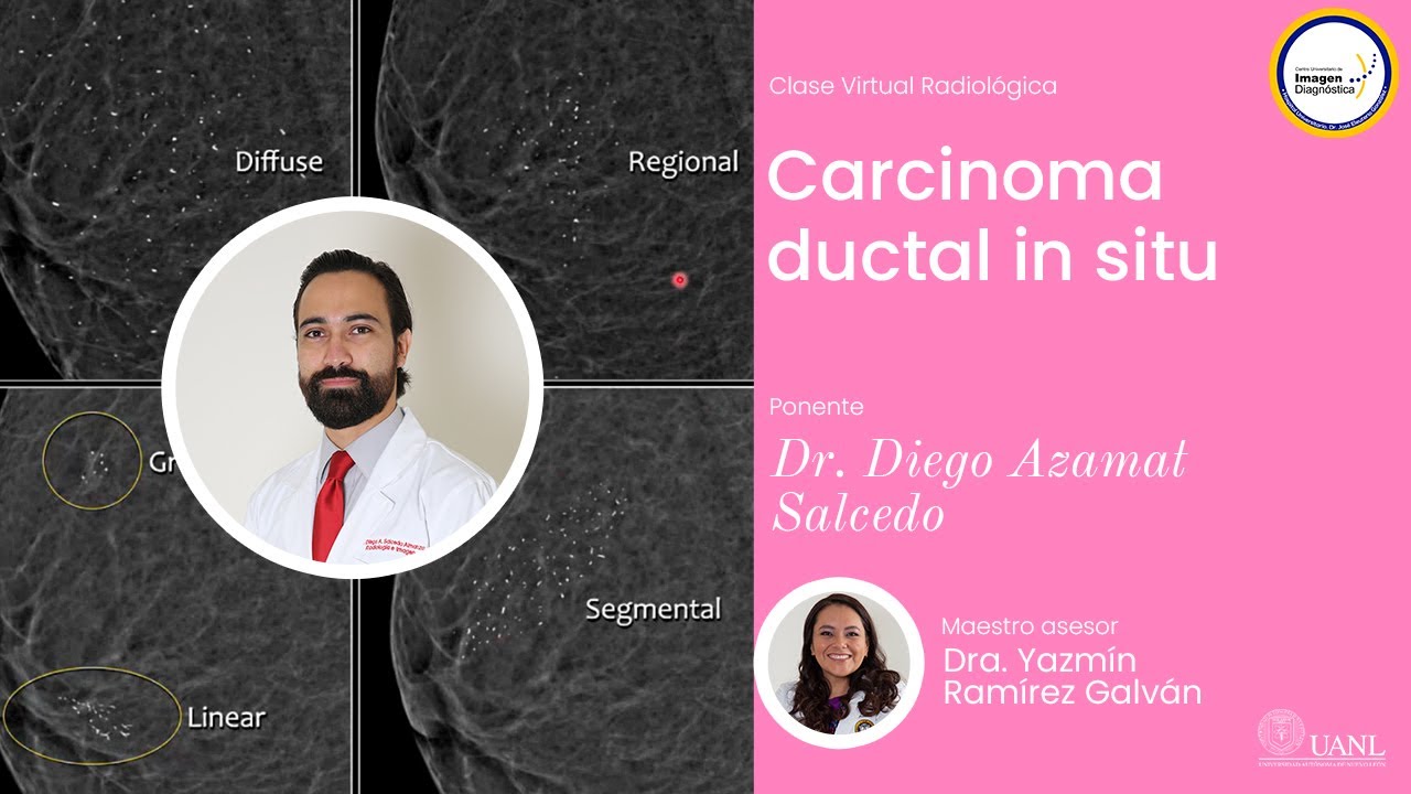 Carcinoma ductal in situ