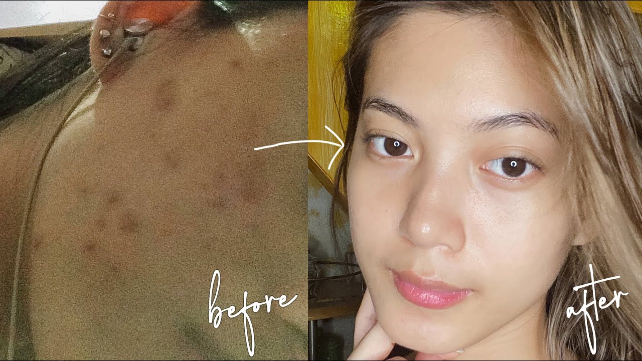 HOW I CLEARED MY SKIN ✨(ACNE JOURNEY + SKINCARE ROUTINE 2020)