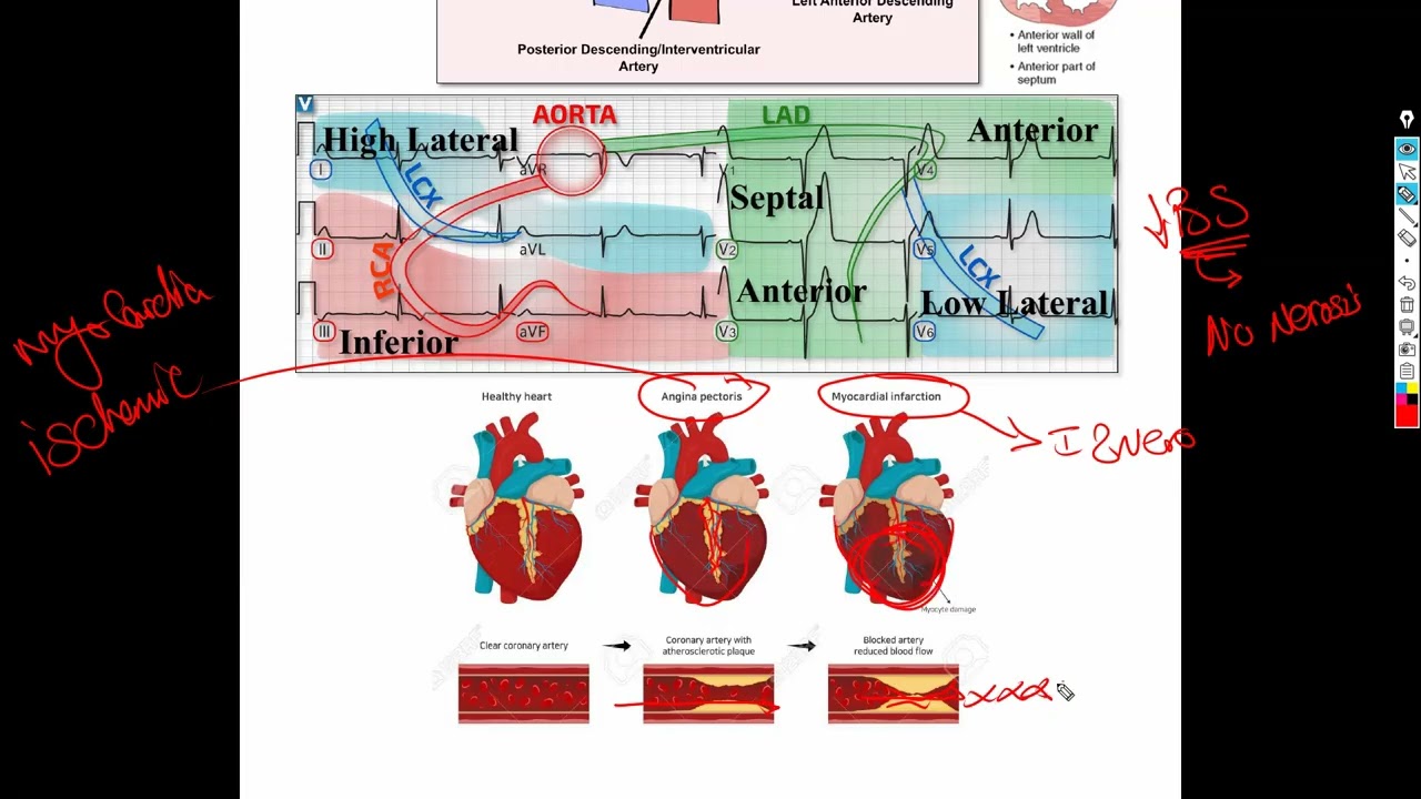 4- Ischemic Heart Disease (Coronary artery disease) شرح باطنة دكتور سويلم