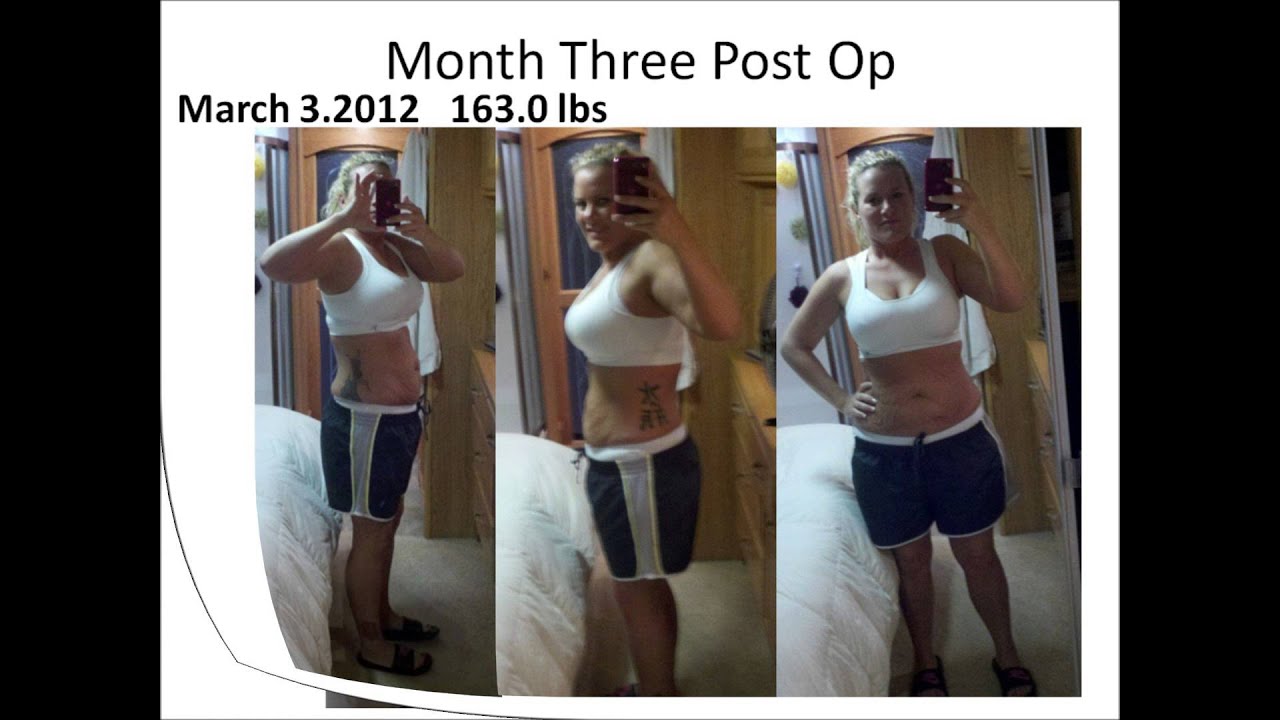 Stephanie's Gastric Sleeve Before and After Photo Sideshow Montage