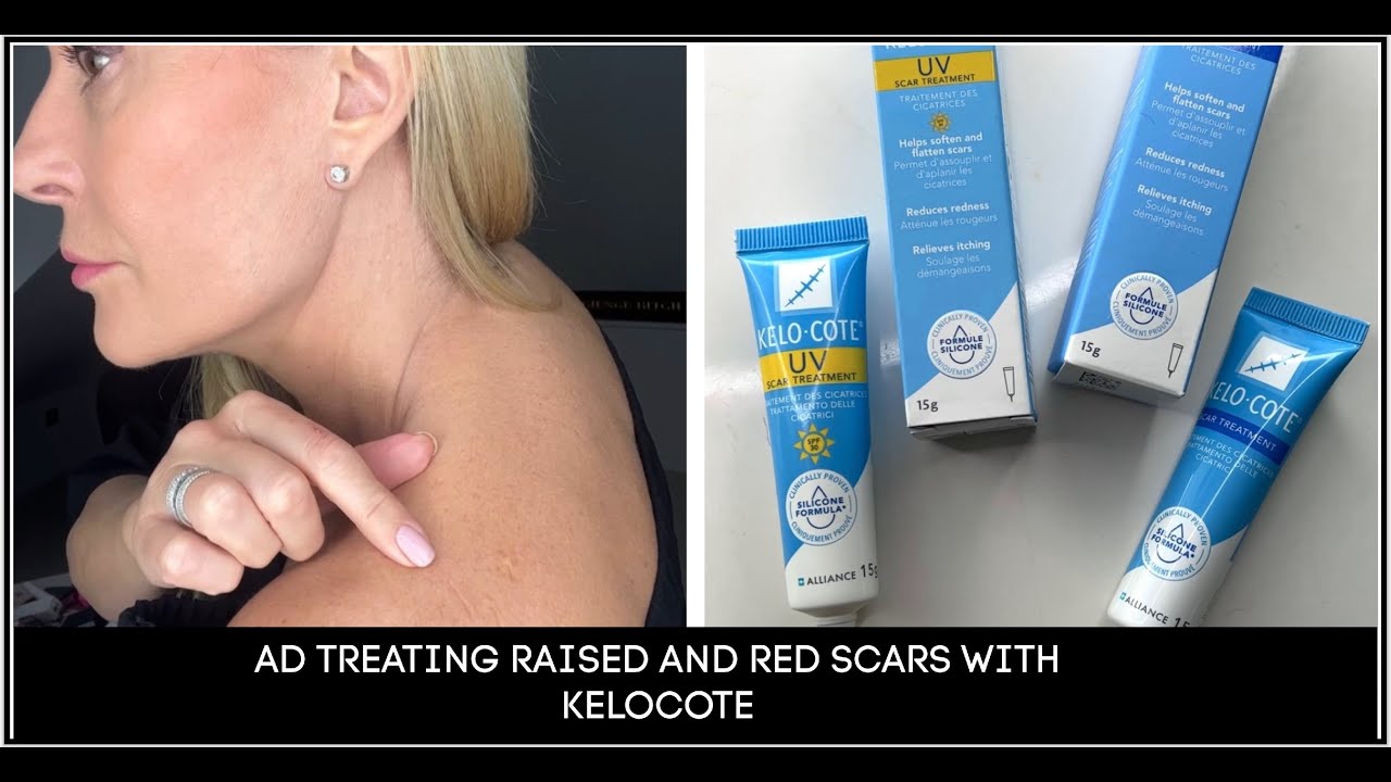 AD TREATING RAISED RED SCARS WITH KELOCOTE