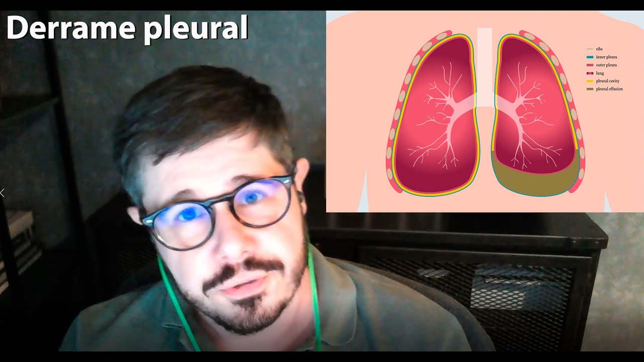 Derrame pleural - água no pulmão - líquido na pleura