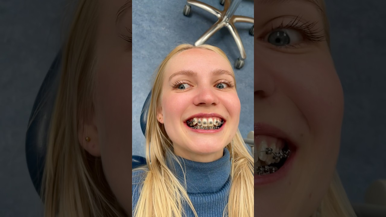 Hebben jullie beugel tips?? 😬