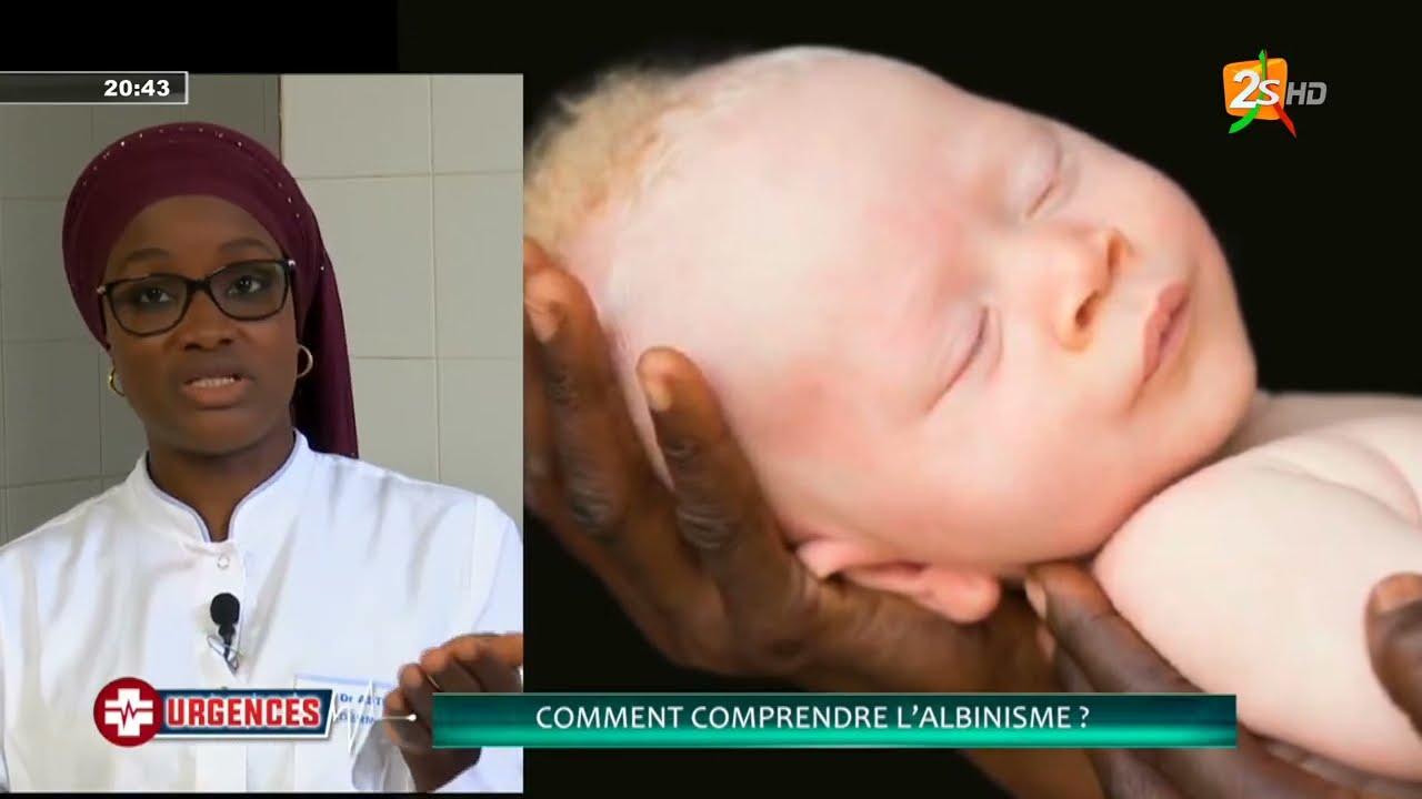 🛑URGENCES AVEC Dr ASTOU DIOUF KEBE : COMMENT COMPRENDRE L'ALBINISME? | JEUDI 21 JUILLET 2022