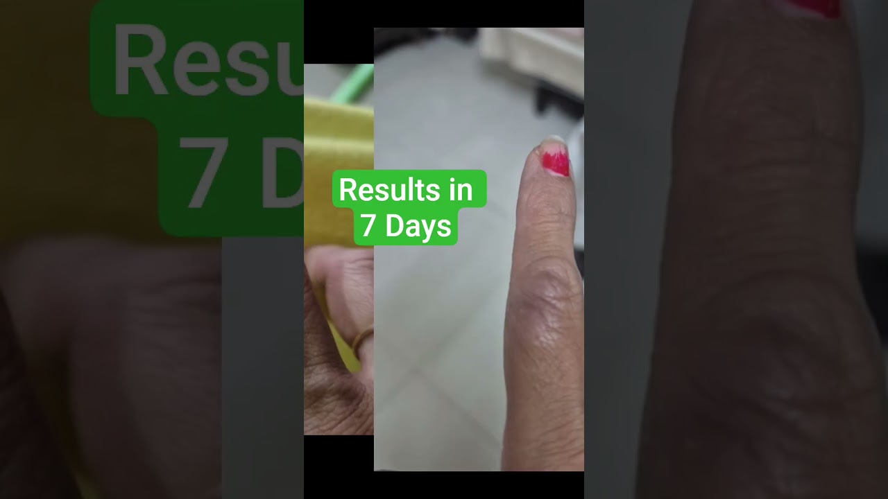 Finger Psoriasis 7 Din Mein Control | Homeopathic Treatment | Real Improvement 
