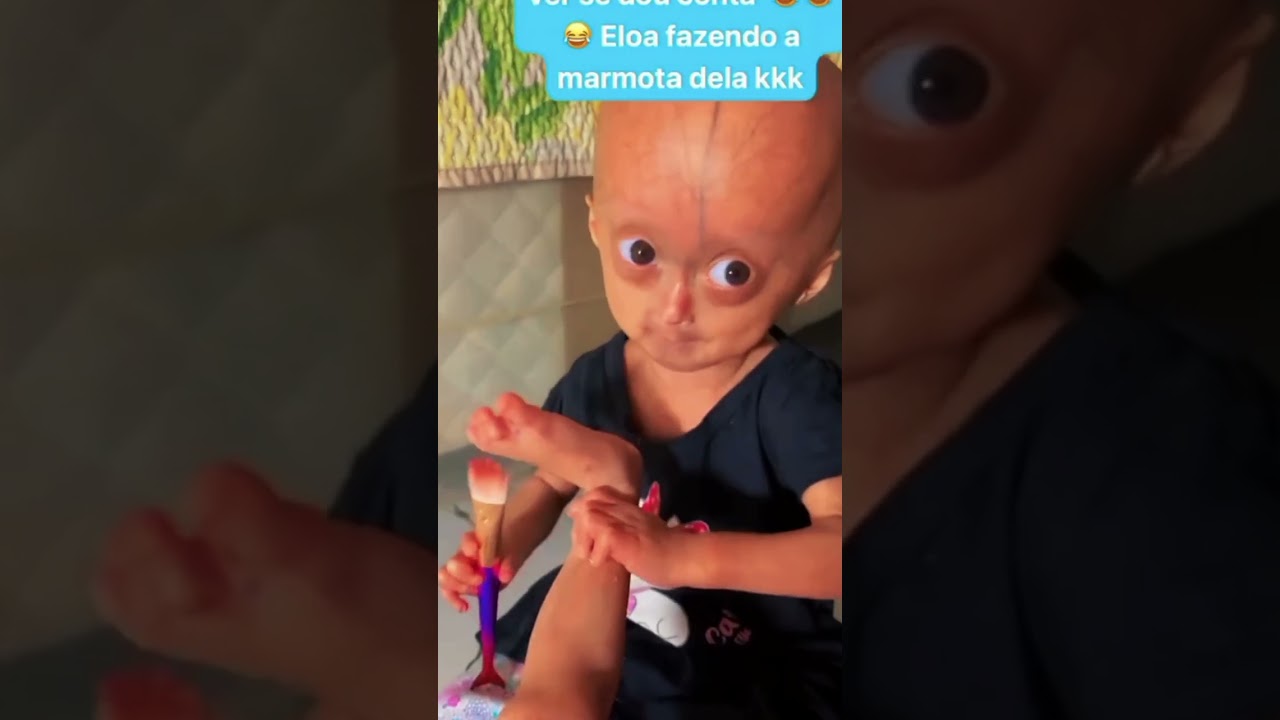 EliseElo&aacute;  #progeria #irmagemeas #eliseeloa #criancasespeciais #fyp #eloa