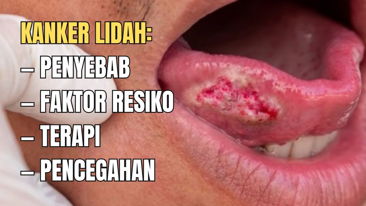 KANKER LIDAH - #doktergigigaul #gigital