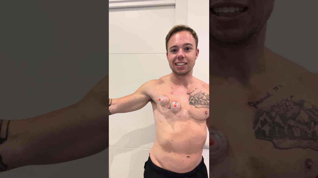 Cupping After Top Surgery | Safe Technique & Benefits Explained